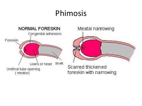 phimosis photos|phimosis anatomy.